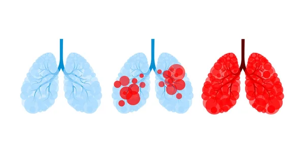 Tres Pasos Enfermedad Pulmonar Con Virus Células Virales Comiendo Pulmón — Vector de stock