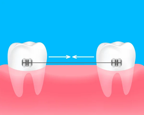 Denti Spaziali Bretelle Tenere Uniti Denti Concetto Cura Dentale Illustrazione — Vettoriale Stock