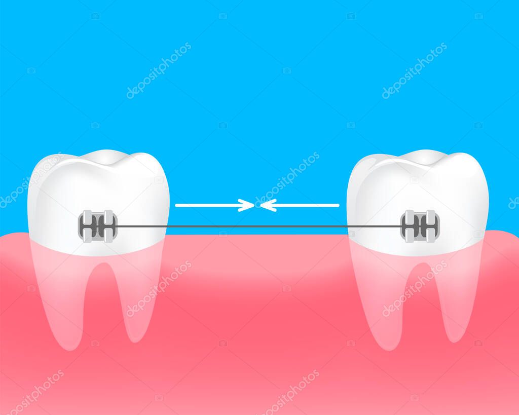 Spacing teeth. Braces to keep the teeth together. Dental care concept. Gums and teeth illustration.