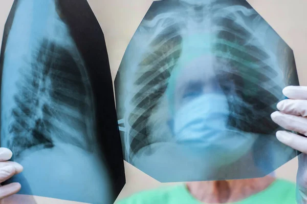 Egy Orvos Pulmonológus Orvosi Egyenruhában Megvizsgálja Beteg Tüdejének Röntgenjét Két — Stock Fotó