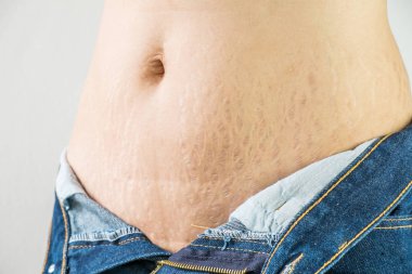 Karın bölgesinde iz bırakan kadın.