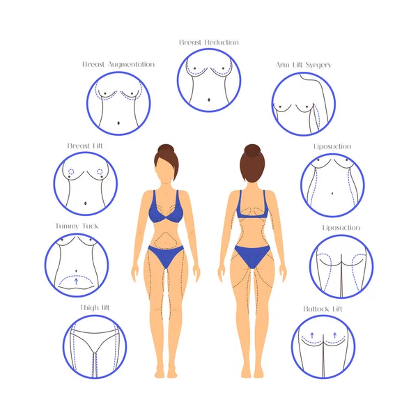 Plastic Surgery Woman Body Infographics (en inglés). Vector — Archivo Imágenes Vectoriales