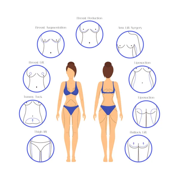 Cirurgia Plástica Mulher Corpo Infográficos. Vetor —  Vetores de Stock