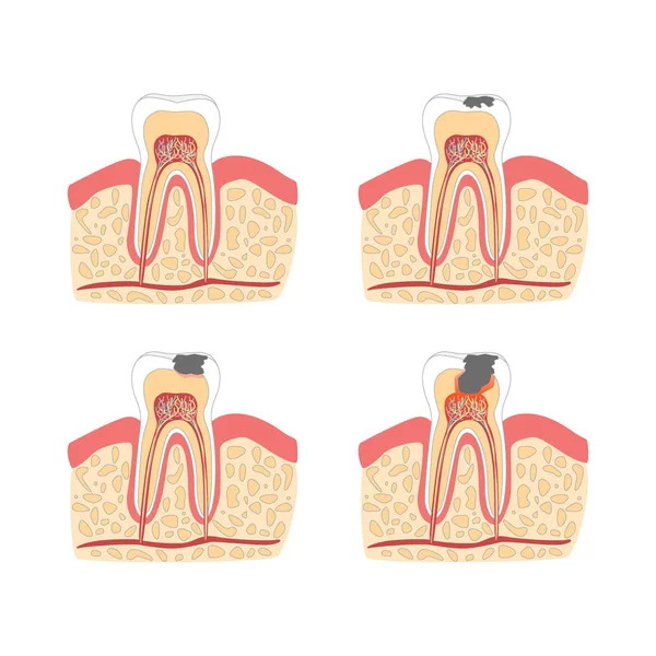 Dente del fumetto con fasi di formazione della carie dentale Set. Vettore — Vettoriale Stock