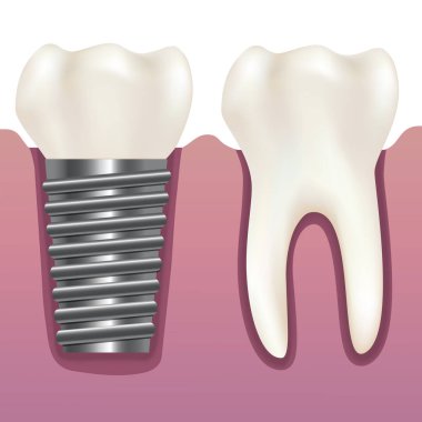 Gerçekçi insan diş ve diş implantı. Vektör