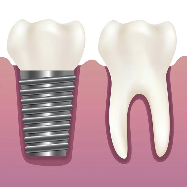 Dente umano realistico e impianto dentale. Vettore — Vettoriale Stock