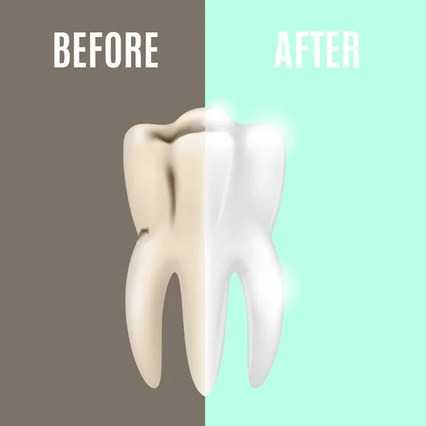 Δόντια που λευκαίνουν τα πριν και μετά. Διάνυσμα — Διανυσματικό Αρχείο