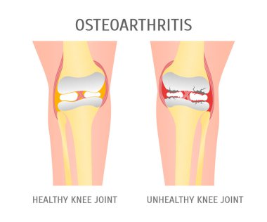 Çizgi film osteoartrit diz sağlıklı ve sağlıksız. Vektör