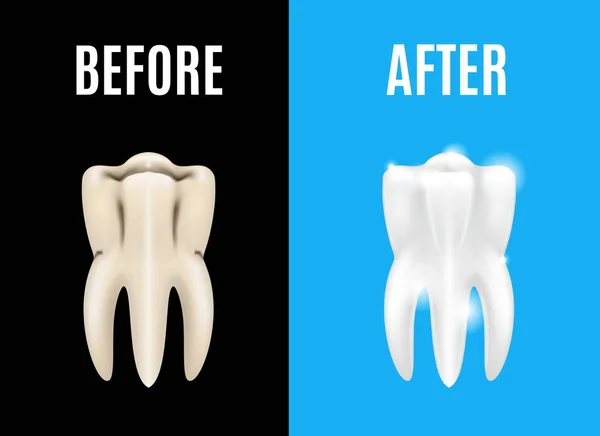 Δόντια που λευκαίνουν τα πριν και μετά την κάρτα αφίσα. Διάνυσμα — Διανυσματικό Αρχείο