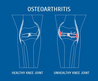 İnce çizgi osteoartrit diz sağlıklı ve sağlıksız. Vektör