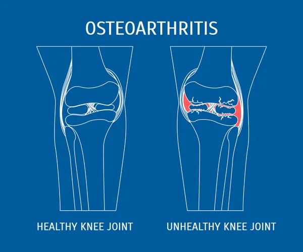 Tenká linie Artróza zdravé a nezdravé koleno. Vektor — Stockový vektor
