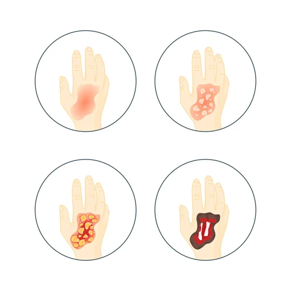 Set di icone bruciature della pelle umana. Vettore — Vettoriale Stock
