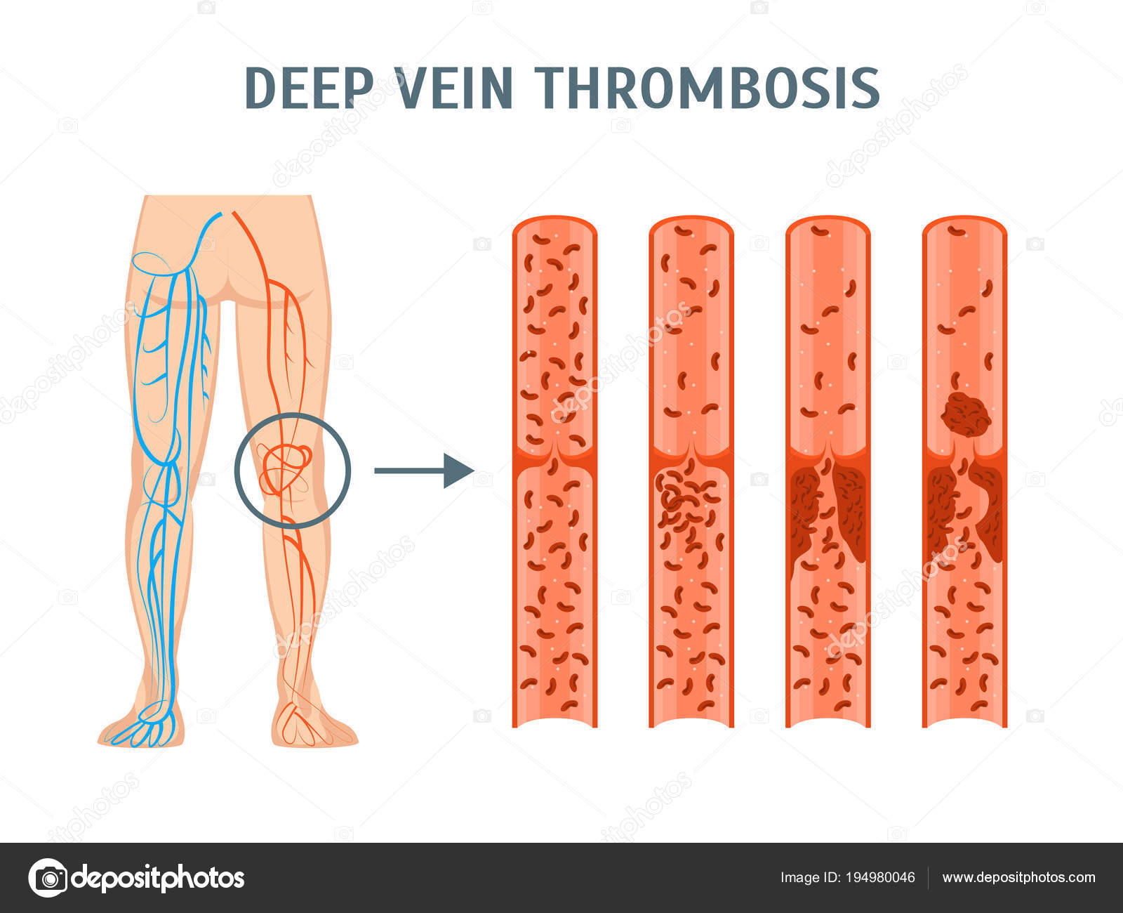 Deep Vein Thrombosis Anatomical Chart