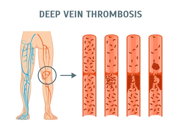 Cartoon Deep Vein Thrombosis Infografica Card Poster. Vettore — Vettoriale Stock