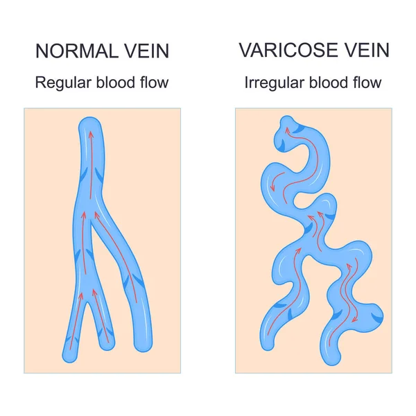 Varicose Veins Concept Banner Card with Elements Ad Poster Card. Vector — Archivo Imágenes Vectoriales