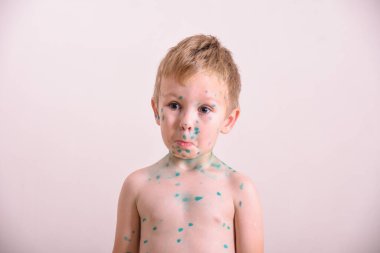 Genç çocuk, suçiçeği olan çocuk. Suçiçeği hastası bir çocuk. Çocuk vücudunda ve yüzünde Varicella virüsü veya suçiçeği kabarcığı kızarıklığı