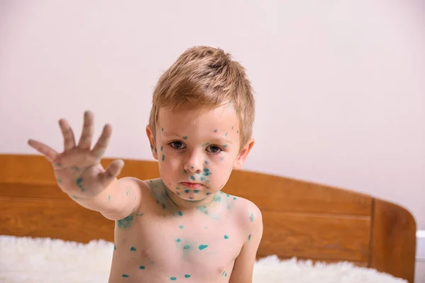 Stock image Young toddler,boy with chickenpox. Sick child with chickenpox. Varicella virus or Chickenpox bubble rash on child body and face