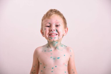 Genç çocuk, suçiçeği olan çocuk. Suçiçeği hastası bir çocuk. Çocuk vücudunda ve yüzünde Varicella virüsü veya suçiçeği kabarcığı kızarıklığı