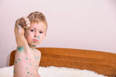 Genç çocuk, suçiçeği olan çocuk. Suçiçeği hastası bir çocuk. Çocuk vücudunda ve yüzünde Varicella virüsü veya suçiçeği kabarcığı kızarıklığı