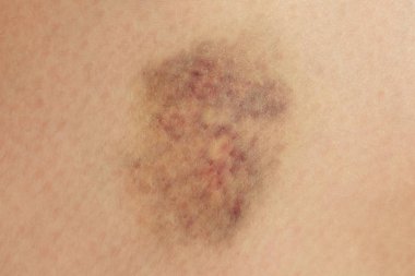 Close up on a bruise on wounded woman leg skin. Gender violence concept clipart