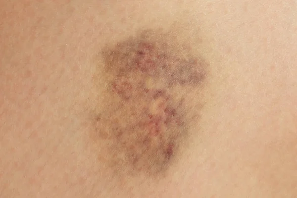 Gros plan sur un bleu sur la peau blessée de la jambe de la femme. Concept de violence de genre — Photo