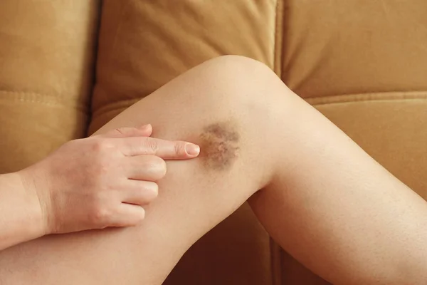 Woman points to a bruise on her leg against the couch — Stock Photo, Image
