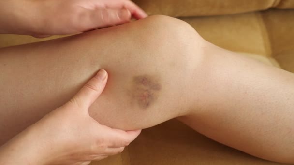 Vrouw onderzoekt en voelt de blauwe plek op haar been — Stockvideo
