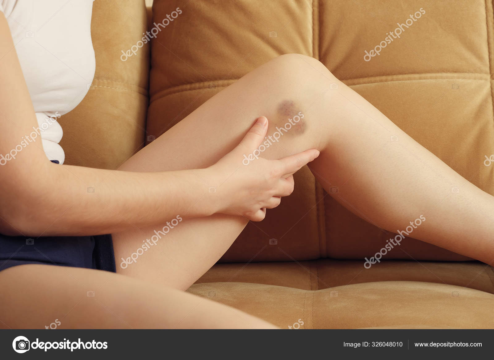 Подкожная гематома写真素材、ロイヤリティフリーПодкожная гематома画像|DepositPhotos, image size:1600x1167