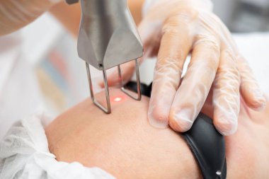 Eller kadının alnına lazer gençleştirme yapıyor.