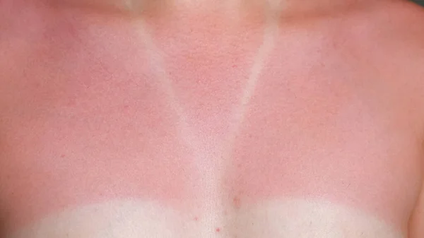 Mujer joven desnuda quemado por el sol rojo pecho y cuello primer plano — Foto de Stock