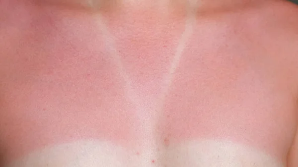 Young woman bare sunburned red chest and neck closeup — Stock Photo, Image