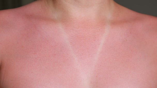 Young woman bare sunburned red chest and neck closeup — Stock Video