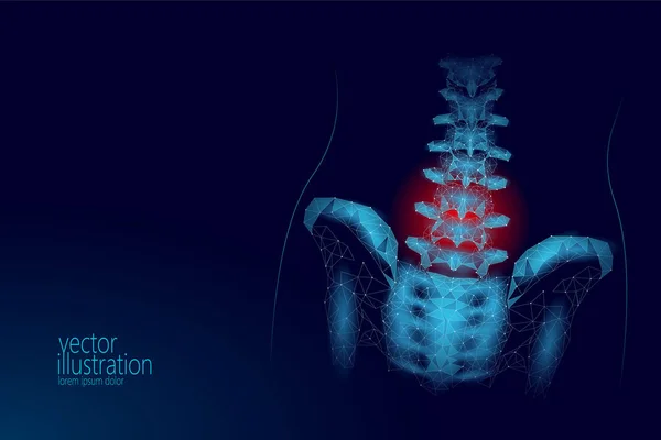 Espina dorsal humana cadera radiculitis lumbar dolor bajo poli. Geométrica poligonal partícula triángulo punto línea futura medicina tecnología azul rojo doloroso área vector ilustración — Vector de stock