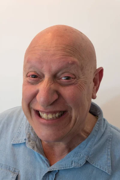 Hombre Mayor Rechinando Dientes Calvo Alopecia Quimioterapia Cáncer Aislado Blanco —  Fotos de Stock