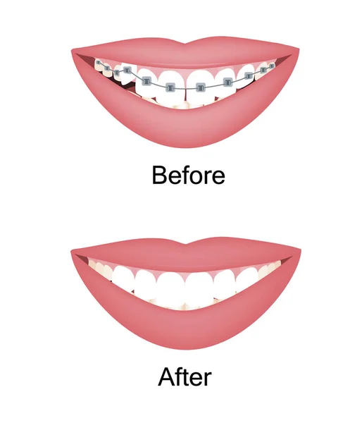 Denti da donna storti prima e dopo il trattamento ortodontico con l'apparecchio. Insieme isolato illustrazione vettoriale — Vettoriale Stock