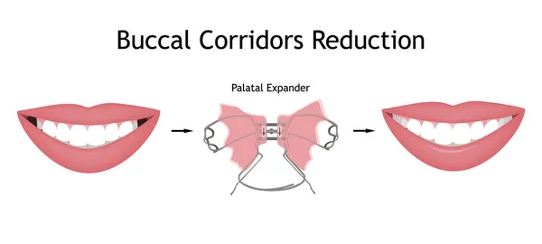 The smile with large and dark buccal corridor before and after the orthotropics or orthotropics correction. Vector illustration. — 스톡 벡터