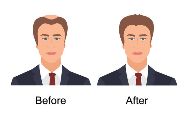 Man with alopecia before and after hair treatment and transplantation. Male baldness problem solution. Health and beauty concept for diagnostic centers and clinics. Vector illustration.