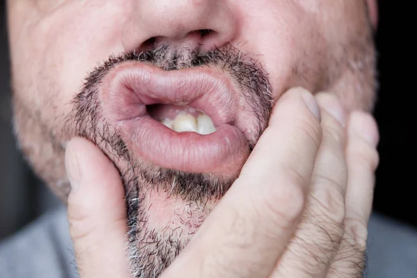 Un hombre sin afeitar arruga su cara con su mano . — Foto de Stock