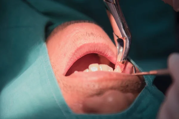 Karieszahnextraktion durch den Zahnarzt. Zahnmedizin im Krankenhaus. — Stockfoto