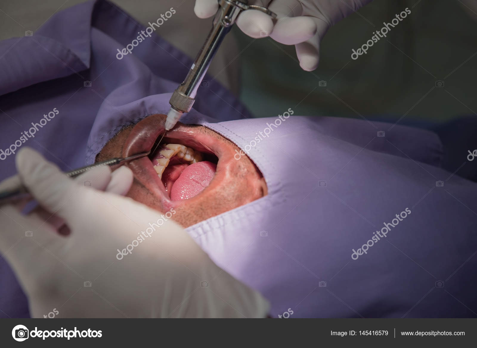 Anesthesia for tooth extraction by the dentist. Dentistry in hospital