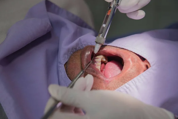 Anesthesia for tooth extraction by the dentist. Dentistry in hospital