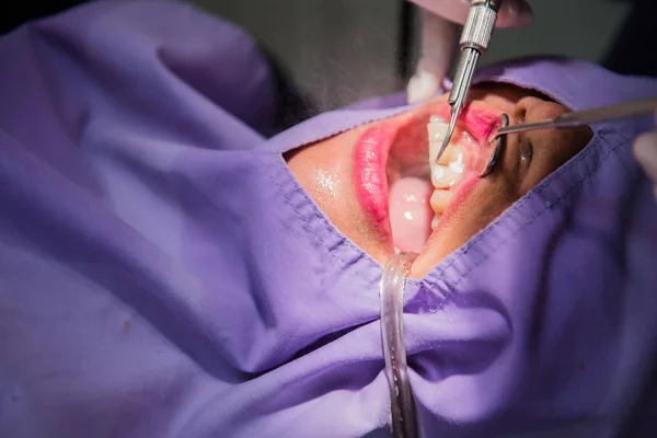 Limpieza dental por el dentista. Odontología en el hospital — Foto de Stock