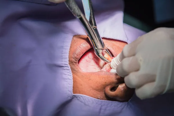 Extracción de dientes de caries por el dentista. Odontología en el hospital — Foto de Stock