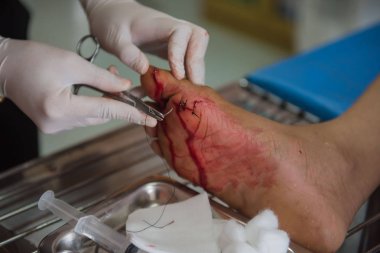 Hastanede doktorlar tarafından ayak dikişli yara. Kazara oluşan yaralar 