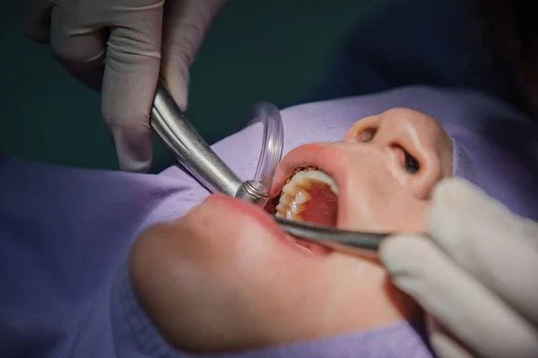 Limpieza dental por el dentista. Odontología en el hospital — Foto de Stock