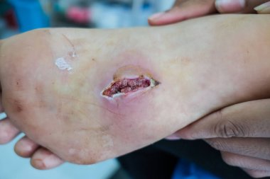 hastalar ayak yarası closeup enfeksiyon 