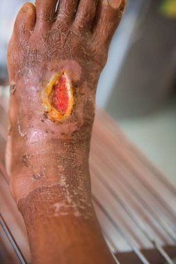 hastalar ayak yarası closeup enfeksiyon .