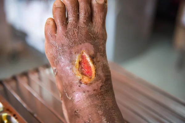 hastalar ayak yarası closeup enfeksiyon .