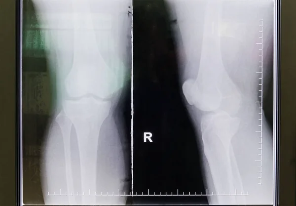 Black and white Knee film X-ray — Stock Photo, Image