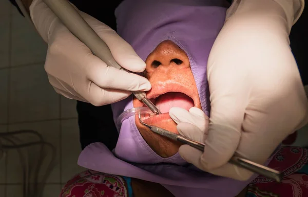 Gebit reinigen door de tandarts. Tandheelkunde in het ziekenhuis — Stockfoto